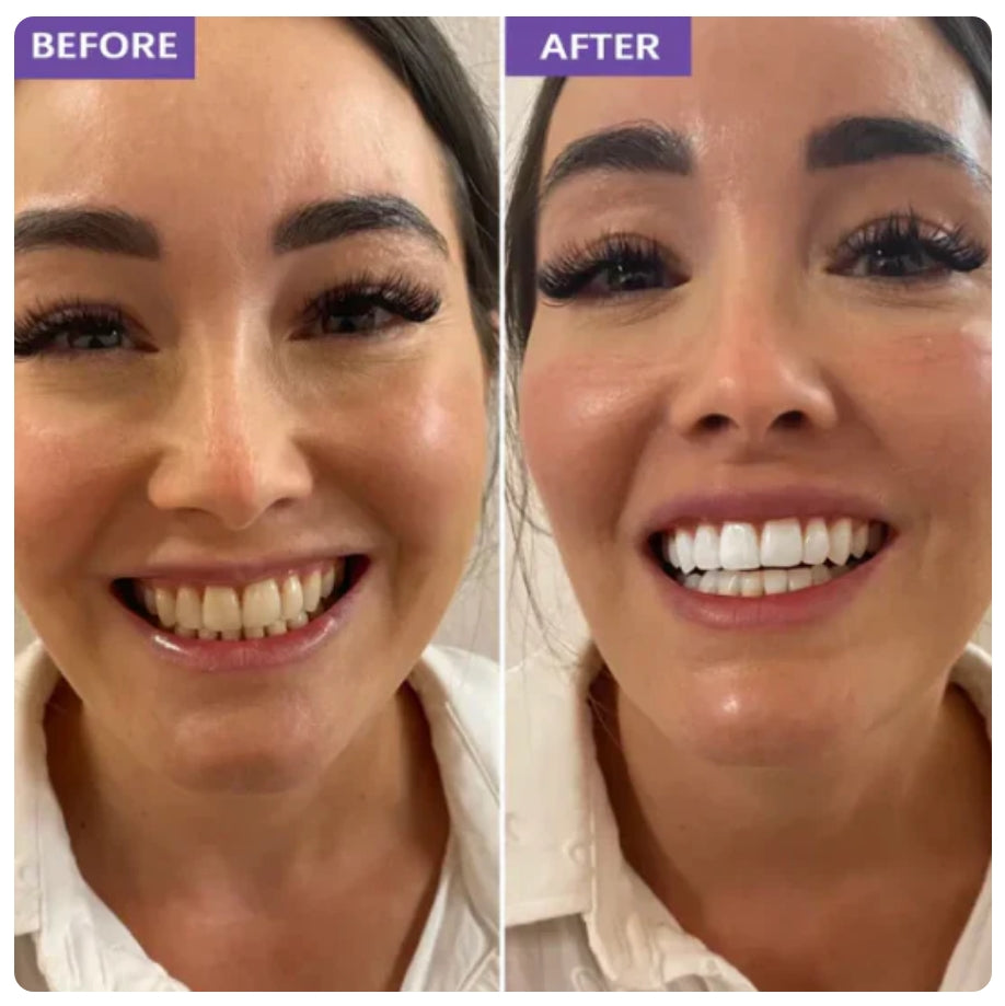 Qluxi Purple Teeth Whitening Strips®