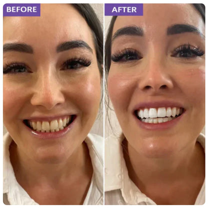 Qluxi Purple Teeth Whitening Strips®